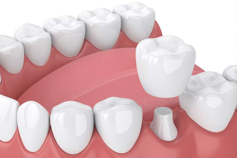 Dental Crowns in Chantilly