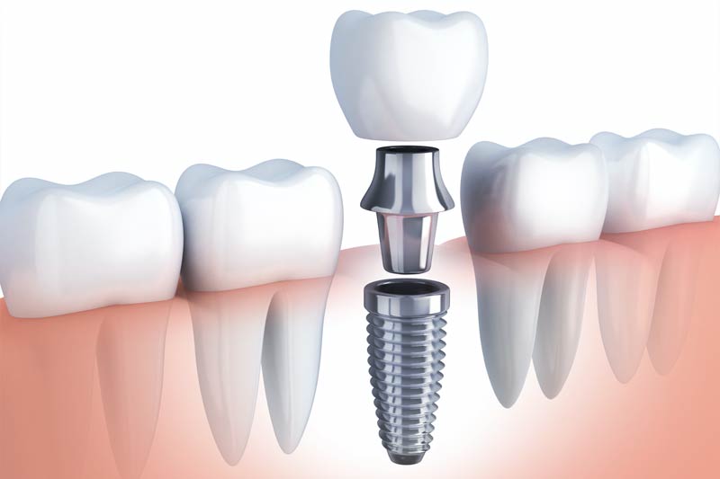 Implants Dentist in Chantilly