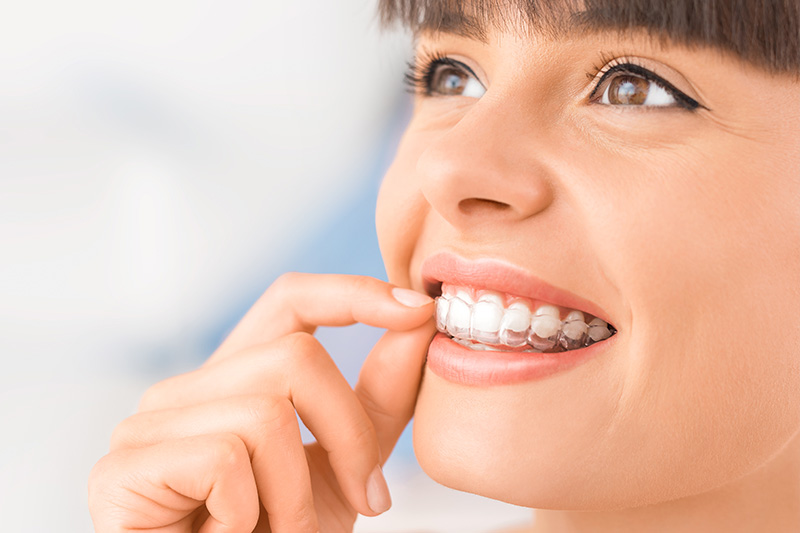 Invisalign in Chantilly