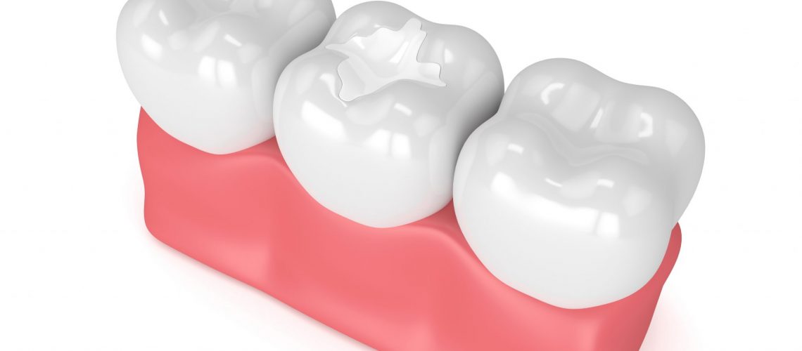 3d render of teeth with dental composite filling in gums over white background